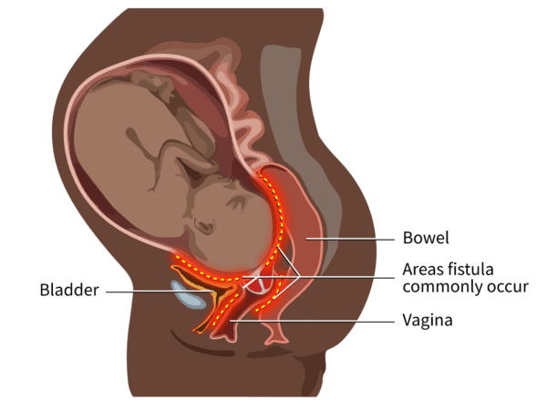What is a fistula?