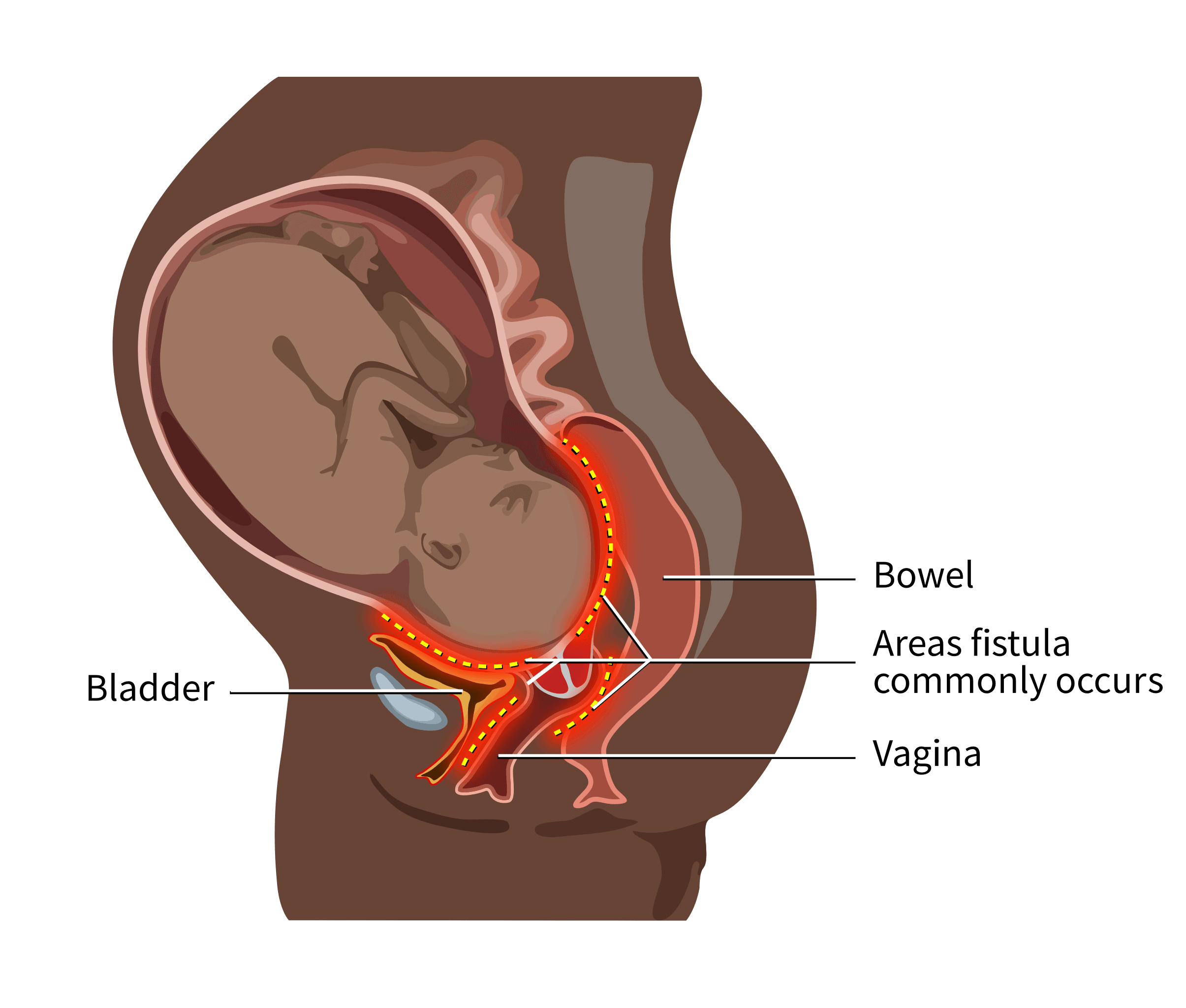 Medical illustration showing how obstetric fistula occurs